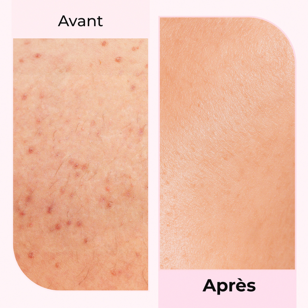 Transformation de la peau avant/après avec LumiSilk - Résultats visibles après utilisation sur peau irritée.
