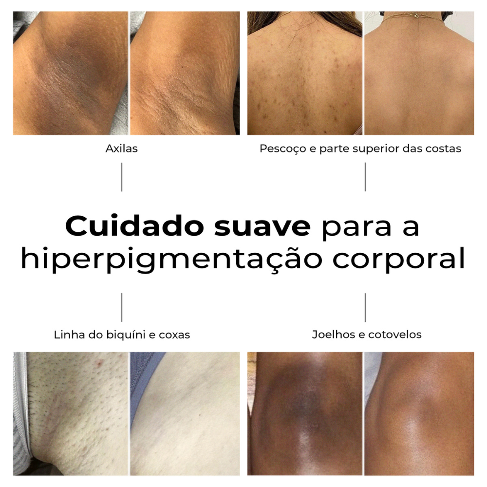 Resultados antes e depois com o sérum Lumen Drop da LumiSilk em casos de hiperpigmentação nas axilas, costas, virilha, coxas, joelhos e cotovelos. Cuidado suave e eficaz para uniformizar o tom da pele.