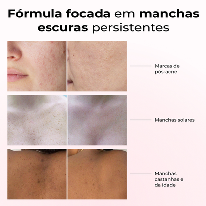 Antes e depois com Lumen Drop da LumiSilk em diferentes tipos de manchas escuras persistentes: marcas de pós-acne, manchas solares e manchas da idade. Fórmula focada em uniformizar e iluminar a pele