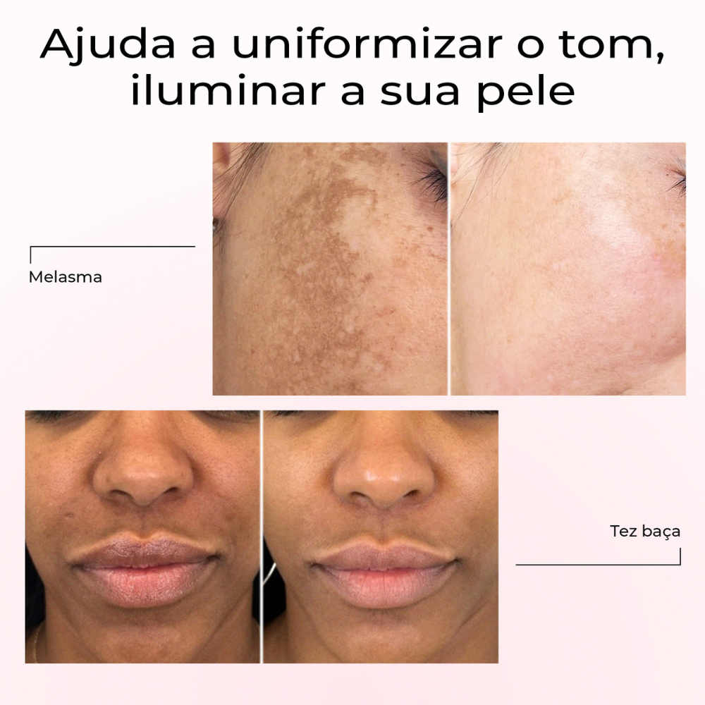 Antes e depois com Lumen Drop da LumiSilk mostrando melhorias em melasma e tez baça. O sérum ajuda a uniformizar o tom da pele e a iluminar visivelmente o rosto