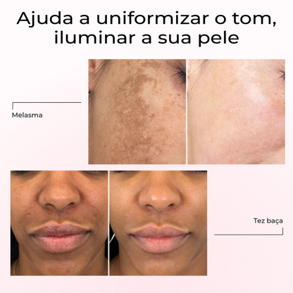 Antes e depois com Lumen Drop da LumiSilk mostrando melhorias em melasma e tez baça. O sérum ajuda a uniformizar o tom da pele e a iluminar visivelmente o rosto