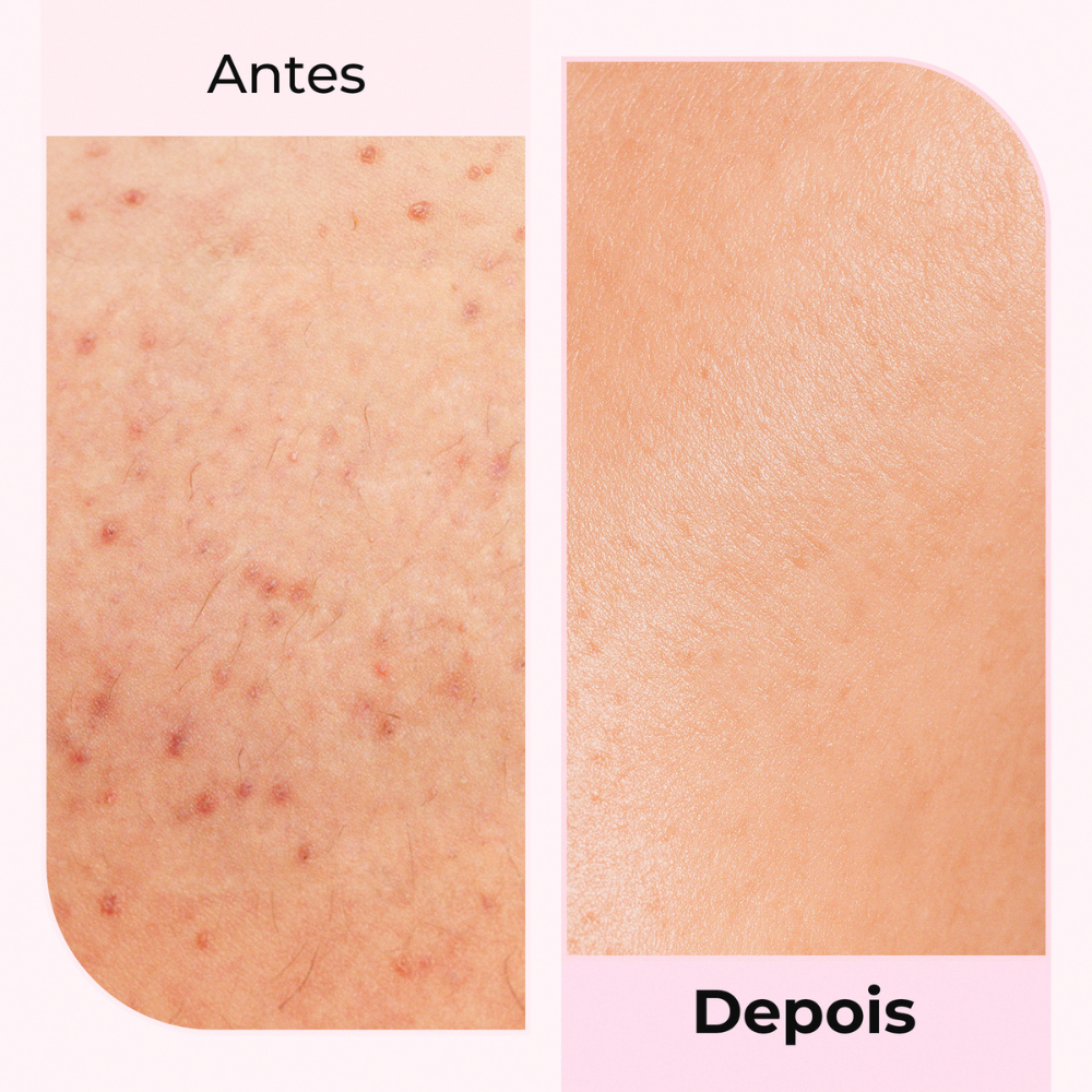 Imagem antes e depois do uso do óleo pós-barba Silky Balloon da Lumisilk, com redução de vermelhidão e pele visivelmente mais suave.